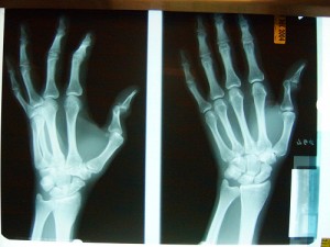 May or not be Chism's actual x-ray. . .